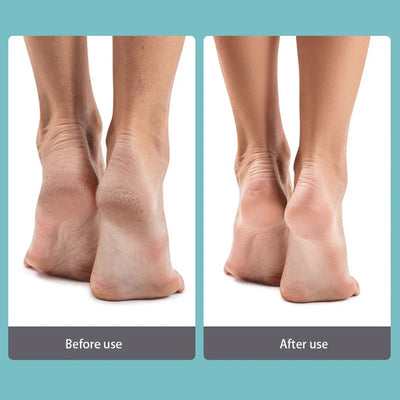 Manual Foot File Callus Remover Rasp Tool